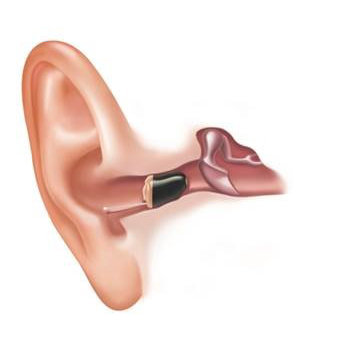 Bild vom Hörgerät